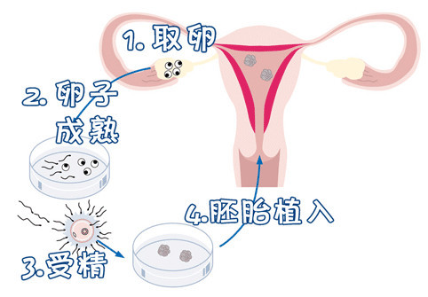 有偿同志供卵代孕怎么预约